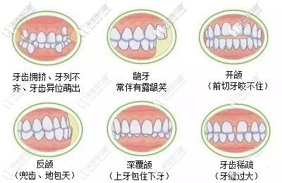 牙齿不齐的症状