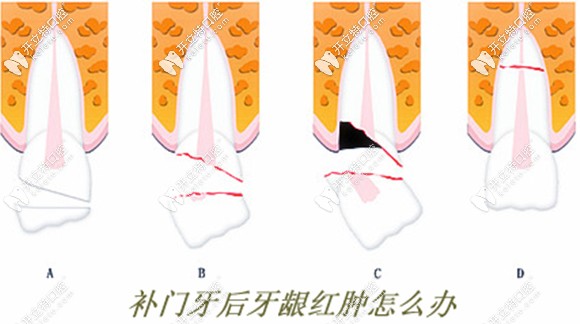 补牙后牙龈红肿的原因