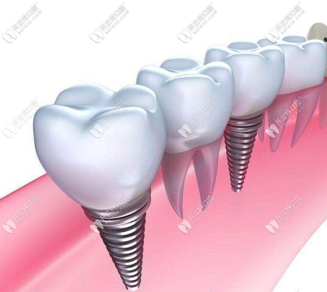 种植牙外观示意图
