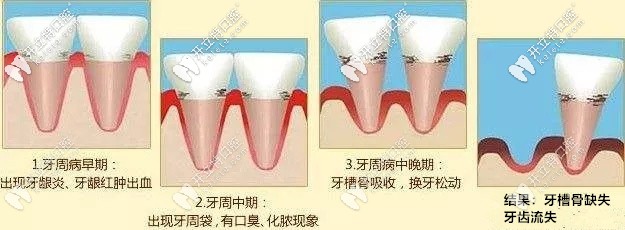 牙周疾病的发展过程