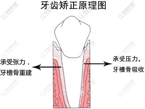 牙齿矫正原理图