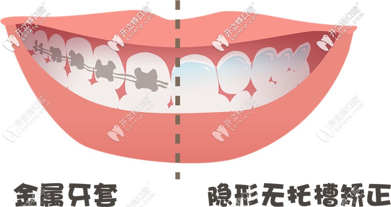 金属牙套和隐形无托槽矫正