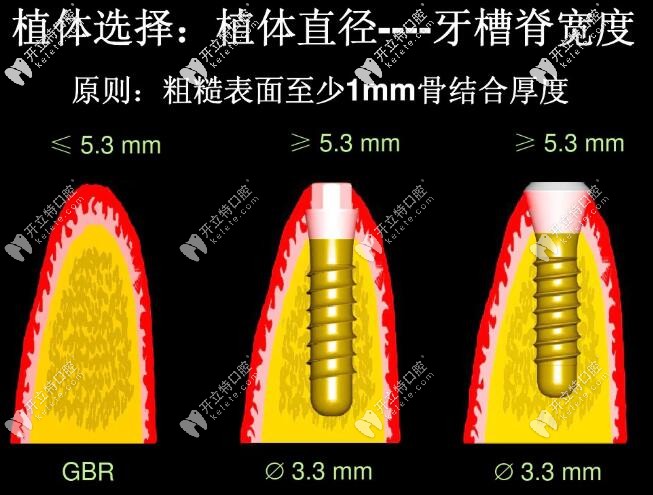 牙槽嵴的宽度图片