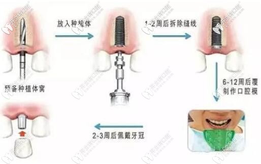 种植牙的过程