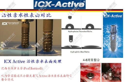 ICX种植体的表面处理技术