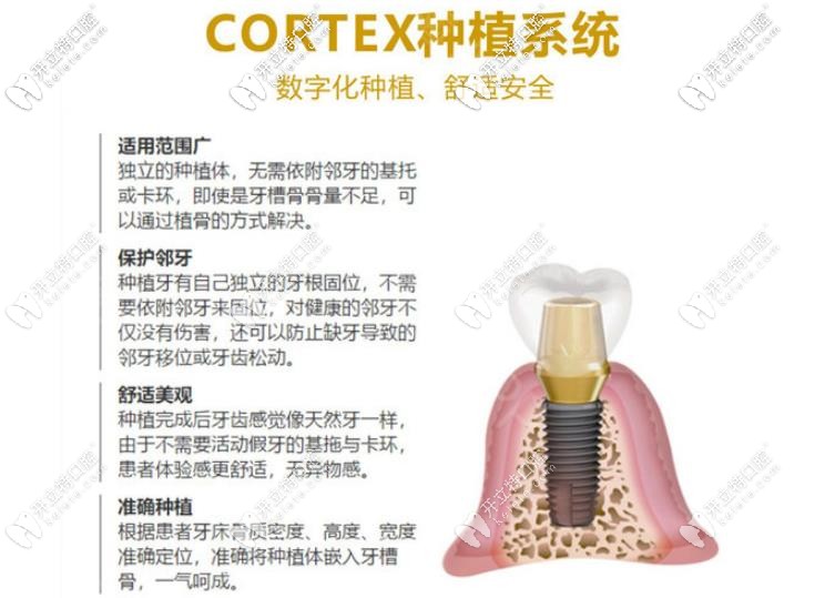 cortex种植体优势