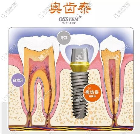 韩国奥齿泰种植体