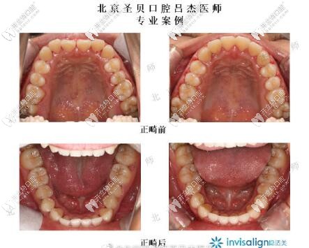北京圣贝齿科吕杰隐形正畸案例前后对比