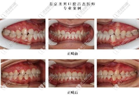 北京圣贝口腔吕杰医师隐适美矫正案例