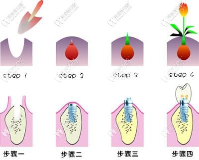 种植牙过程模拟图