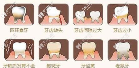 牙齿瓷贴面做了后悔不想要了，可以拆掉吗？