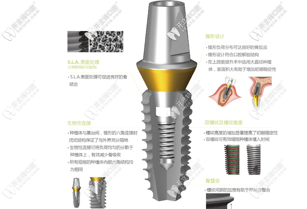 登腾种植体表面处理