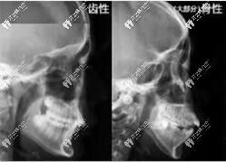 牙性凸嘴和骨性ct情况