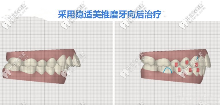 矫正龅牙隐形牙套快还是钢丝牙套快