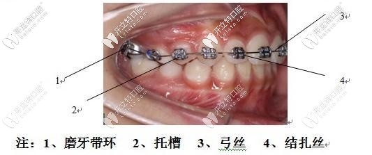 begg细丝弓矫治前牙拥挤