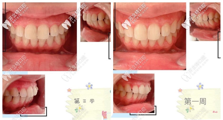 做smilelab矫正打卡21天结束后的对比图