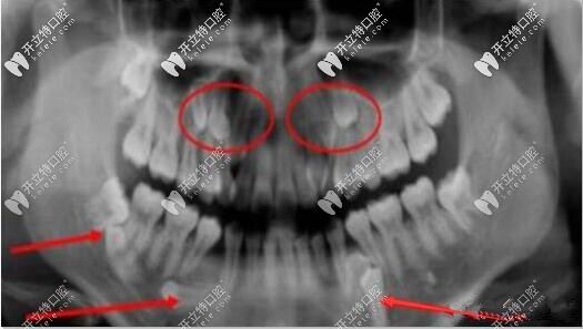 多生牙和智齿大有区别是否要拔除儿童成人处理方式不同