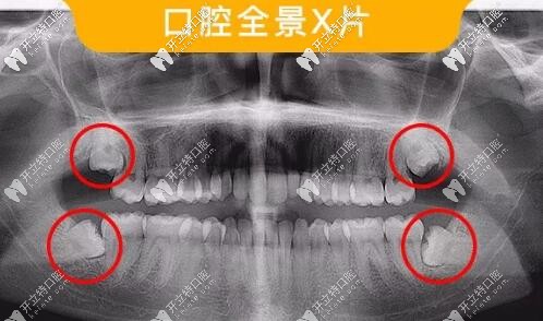 智齒:智齒也稱為第三磨牙,正常人28顆牙,也有人32顆牙,其中4顆就是