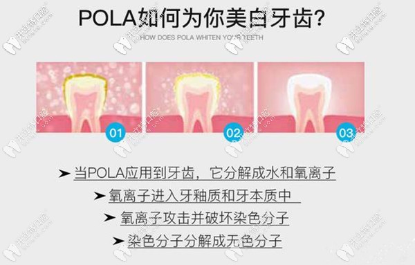 澳洲 SDI POLA 美白牙齿过程