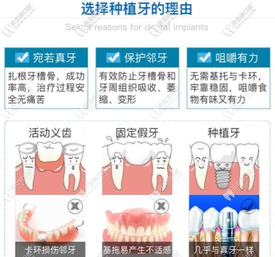 活动义齿固定假牙和种植牙哪个好