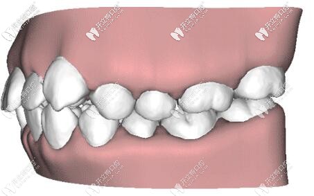 牙齿矫正示意图