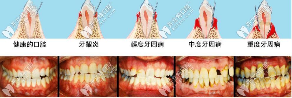 牙周病发展过程