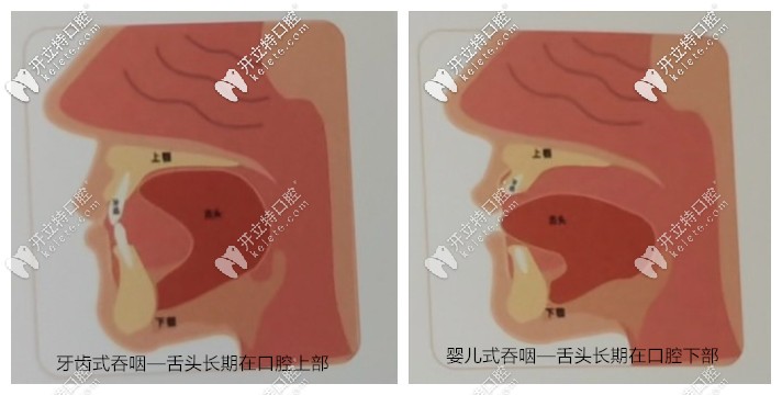 造成异常吞咽模式原因