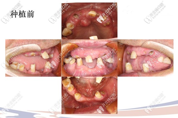 all on 4种植前牙齿情况