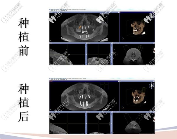 种植牙前后拍片图示