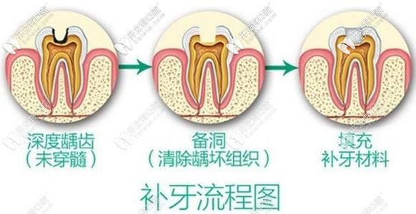 蛀牙别拖久哟!偷偷告诉你杭州做3M树脂补牙的价格在这！