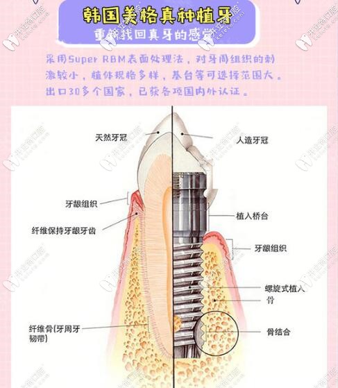 深圳河山口腔韩国美格真进口种植牙特点