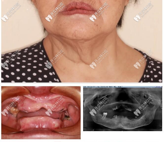 全口无牙颌做种植牙前照片