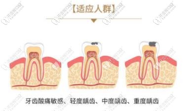 3M补牙适宜人群