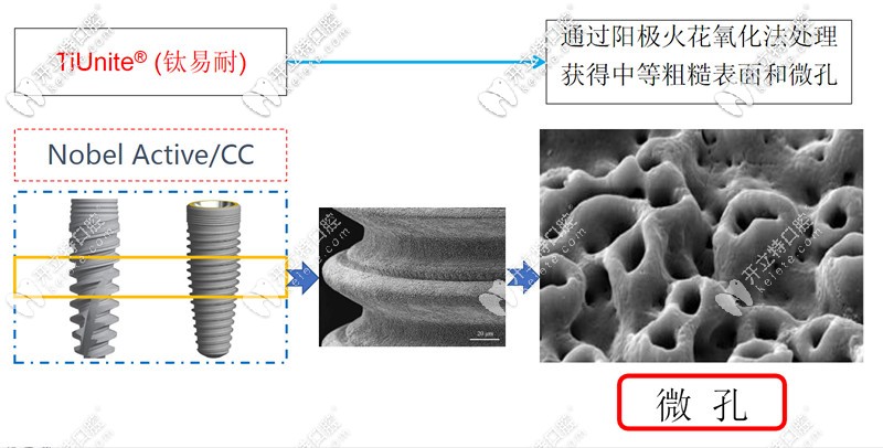 诺贝尔种植体采用钛易耐表面处理