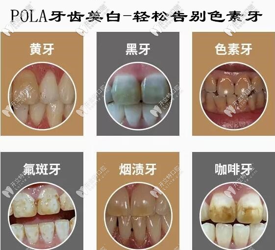 澳大利亚pola牙齿美白诊室装和家庭装的步骤