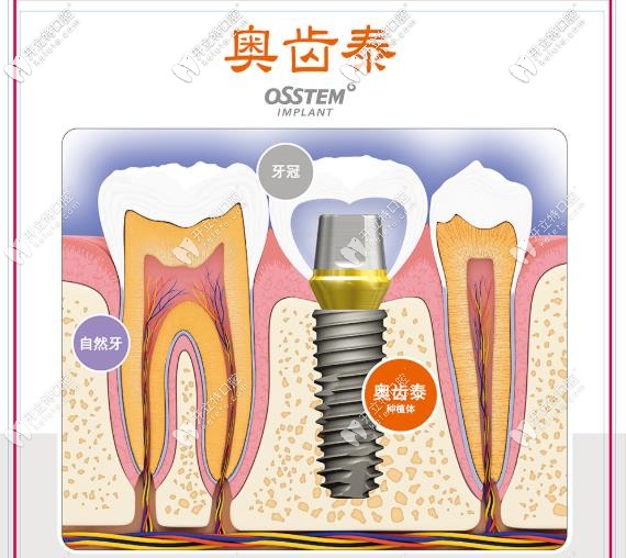 美国hiossen皓圣是奥齿泰吗 植体虽价格差不多但真是不同国的 行业资讯 开立特口腔