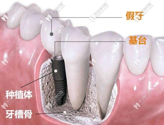 长沙美奥种植牙价格表查询:美奥口腔技术好价格也才3980一颗