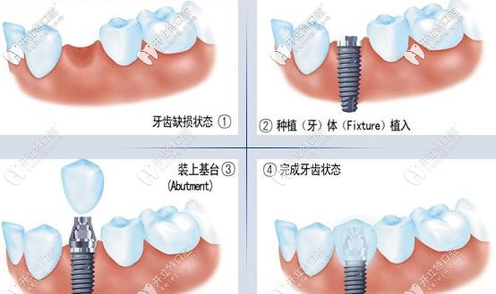种植牙操作过程