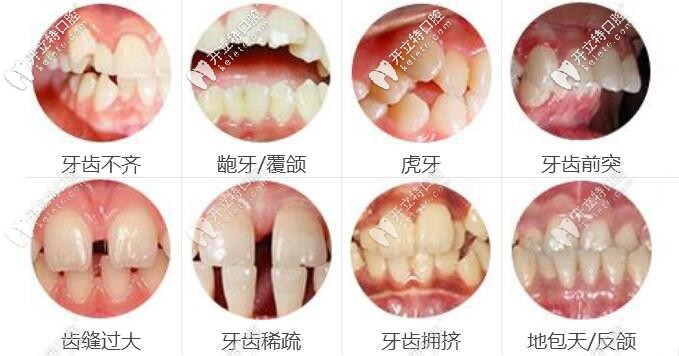 牙齿矫正适应症