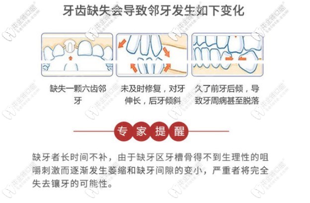 牙齿缺失，千万不要轻忽