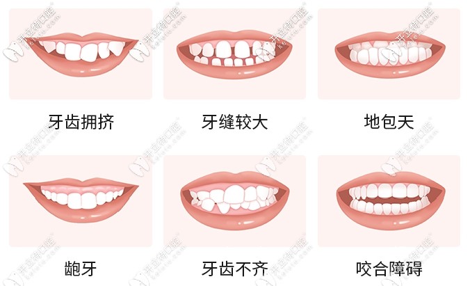 牙齿矫正适应症