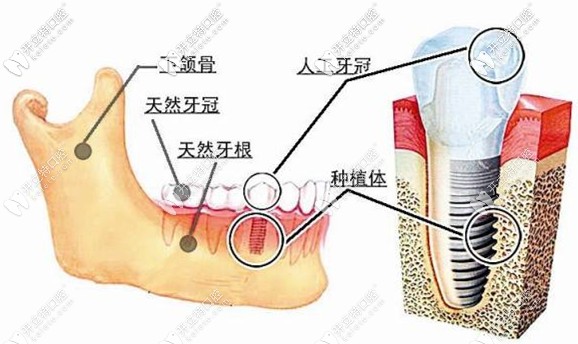 种植牙价格为什么这么贵