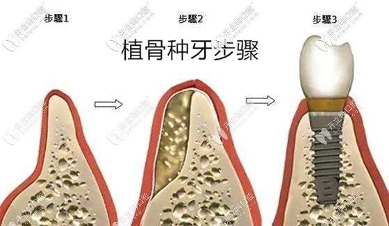 在苏州做种植牙一颗多少钱