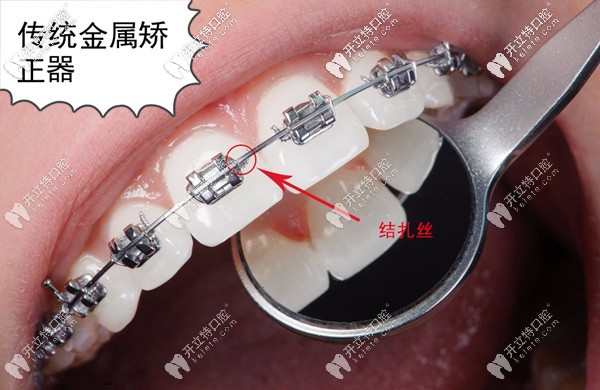 桂林私立口腔医院牙套价格表戳开预览牙齿矫正的收费标准