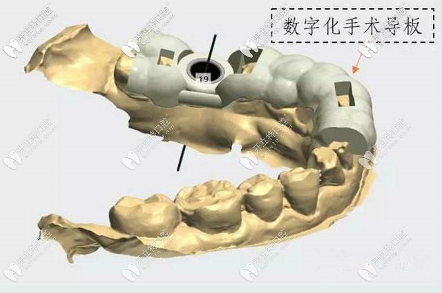 数字化种植技术中的导板