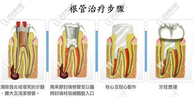 乳牙根管治疗步骤图解图片