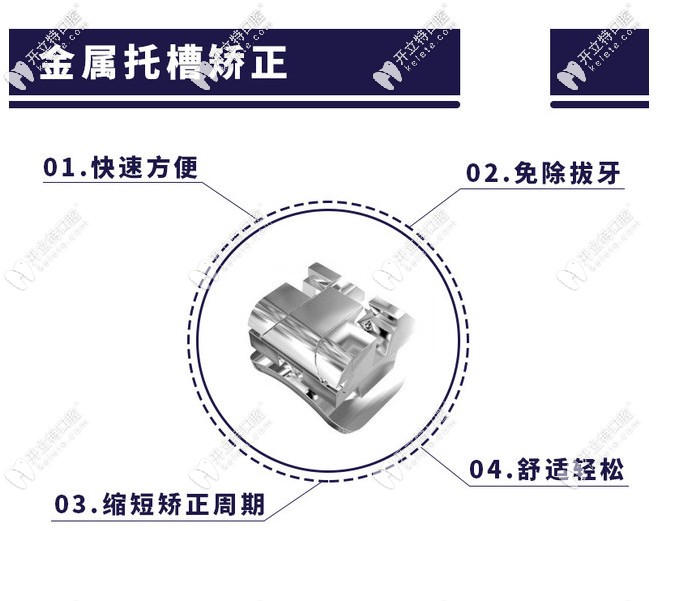 金属托槽的优缺点