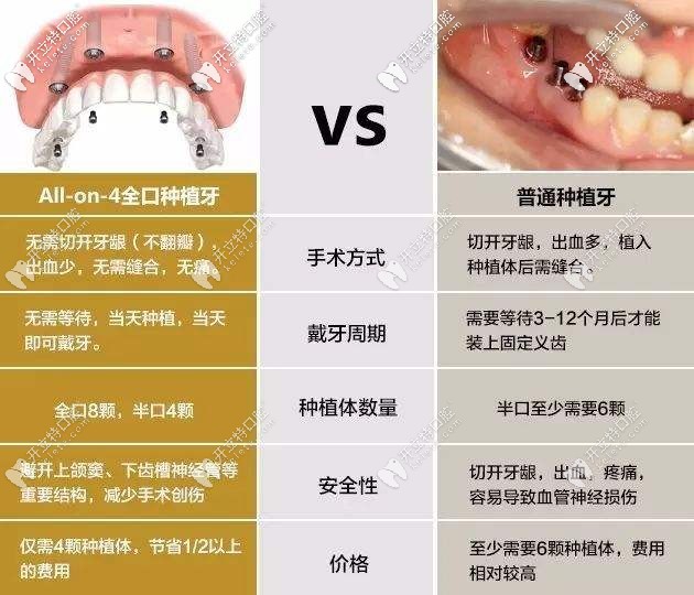 All-on-4种植牙与普通种植牙的区别