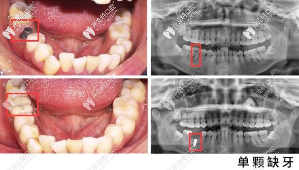 昆明美奥口腔单颗牙种植案例