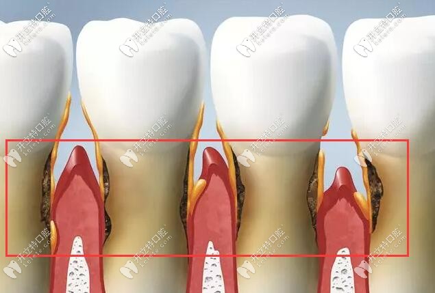 预防牙周病和牙龈萎缩的方法